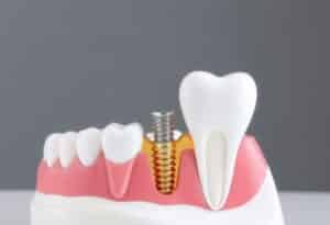 implante dental de diámetro reducido